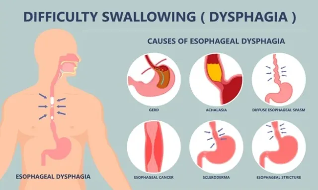 Swallow-Safe Eating: A Nutritional Approach to Dysphagia Swallow-Safe Eating A Nutritional Approach to Dysphagia